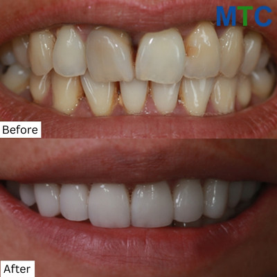 Before & After Dental Treatment in Playa del Carmen