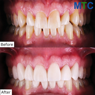 Before & After Dental Treatment in Playa del Carmen