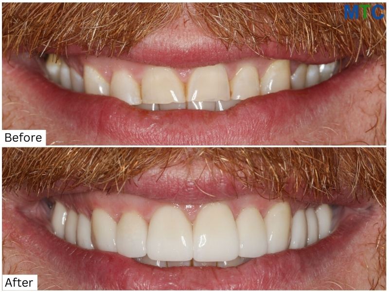 Before & After Dental Work in Puerto Vallarta, Mexico