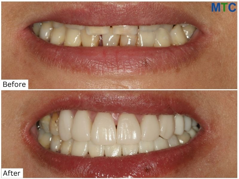 Before & After Dental Work in Puerto Vallarta, Mexico