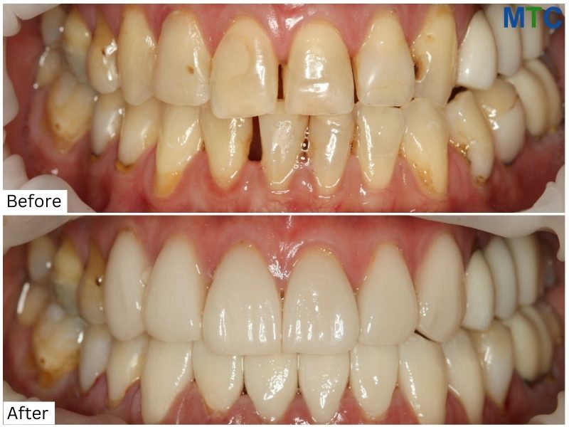 Before & After Dental Work in Puerto Vallarta, Mexico