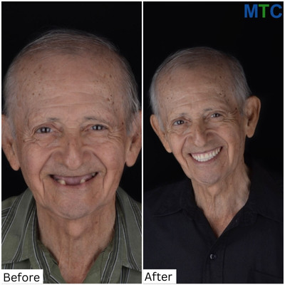 Before & After Full Mouth Implants in Los Cabos, Mexico