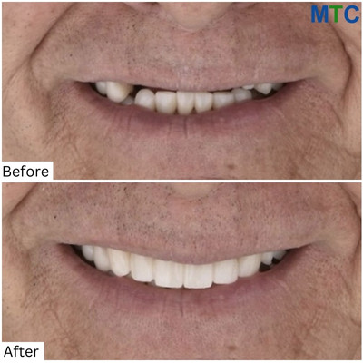 Before and After Full Mouth Implants in Los Cabos, Mexico