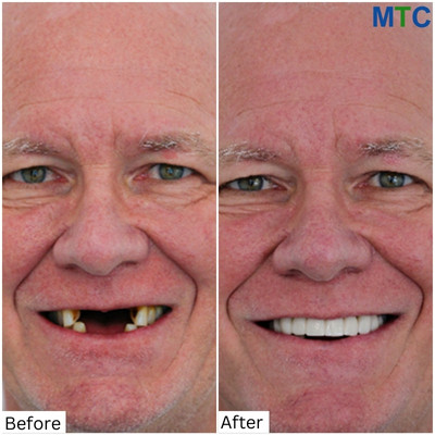 Before & After Full Mouth Implants in Los Cabos, Mexico