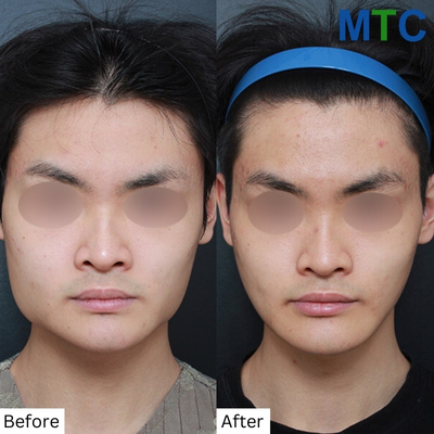 V-Line Chin Surgery