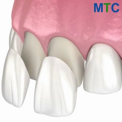 Dental Veneer