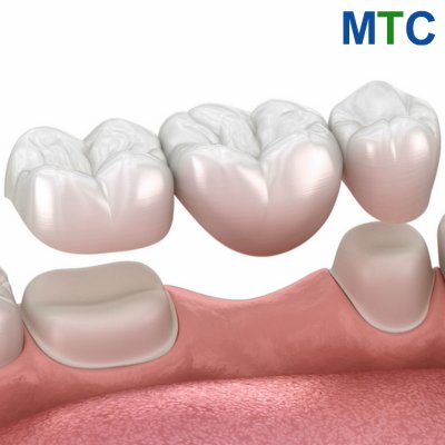 Dental bridges