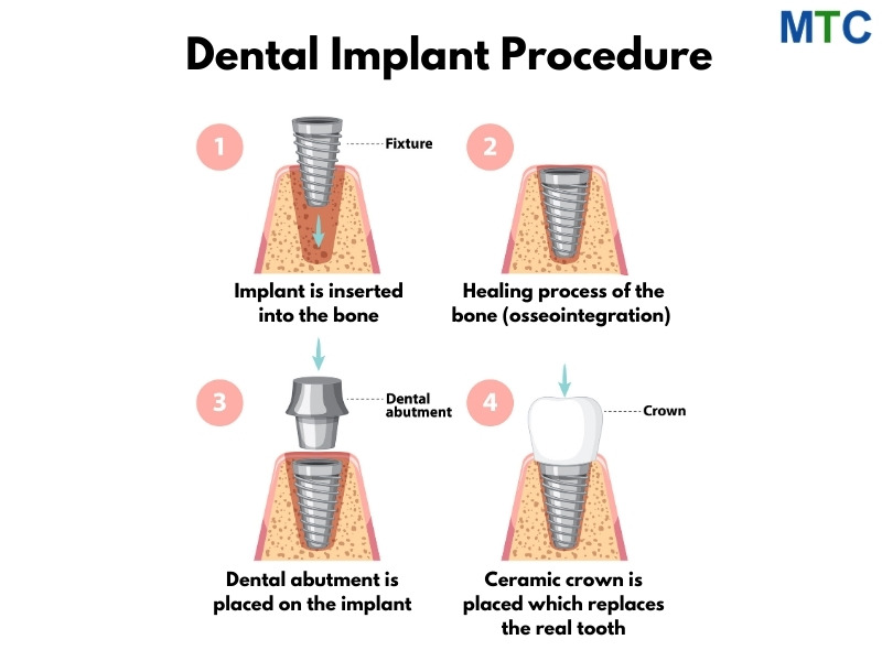 Dental implant elements and its placement procedure