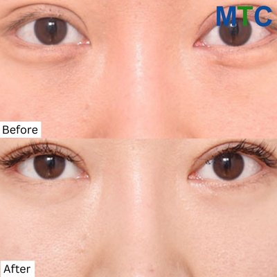 Eye Bag Removal Surgery