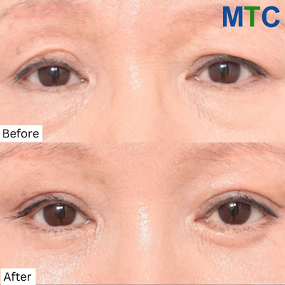 Blepharoplasty of the Eyelids