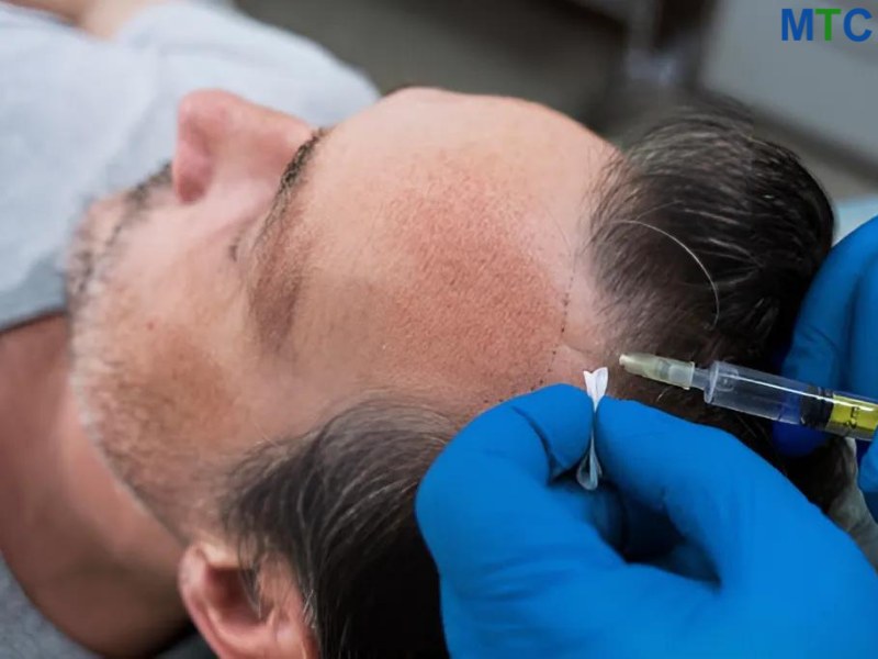 Doctor injecting stem cell mixture into the patient's scalp