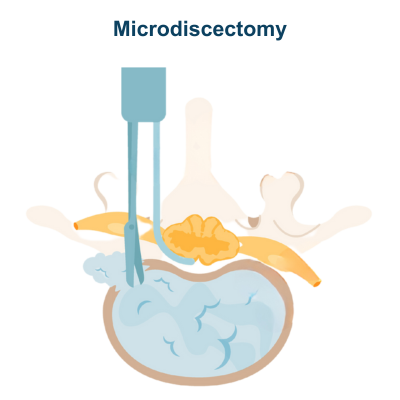 Microdisectomy