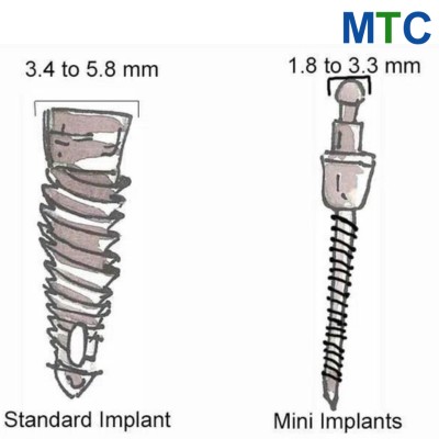 Mini-Dental Implants