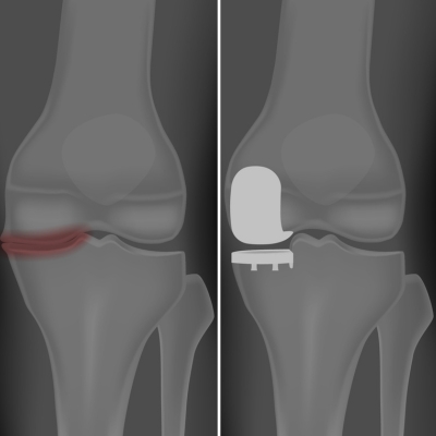 Partial knee replacement at Chennai