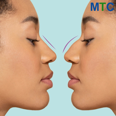 Nose rhinoplasty