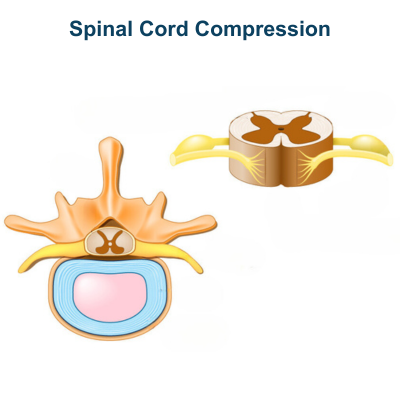 Spinal Cord Compression