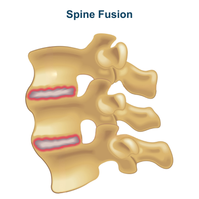 Spine Fusion