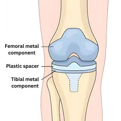 Diagram showing Structure of Knee Implant