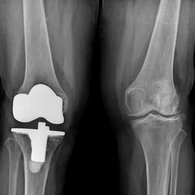 Unilateral knee replacement in Chennai 