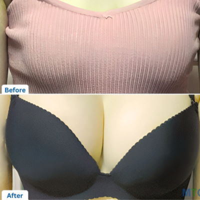 Breast Augmentation: Before and After