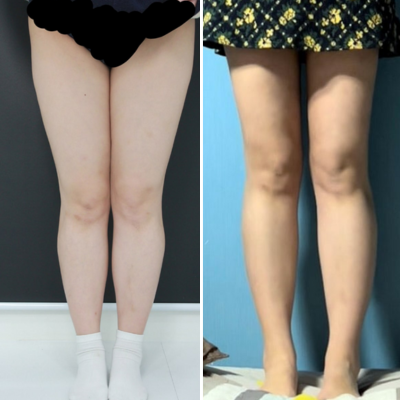 Liposuction: Before and After