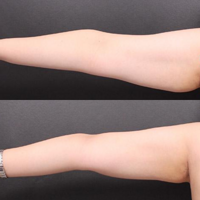 Arm fat removal: Before and After