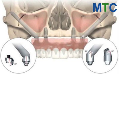 Zygomatic Implants