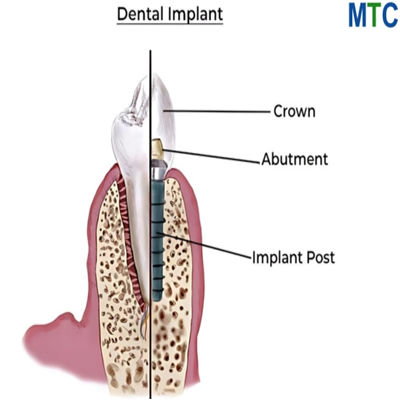 dental implant