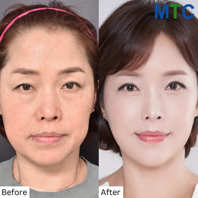 Facelift Before and After