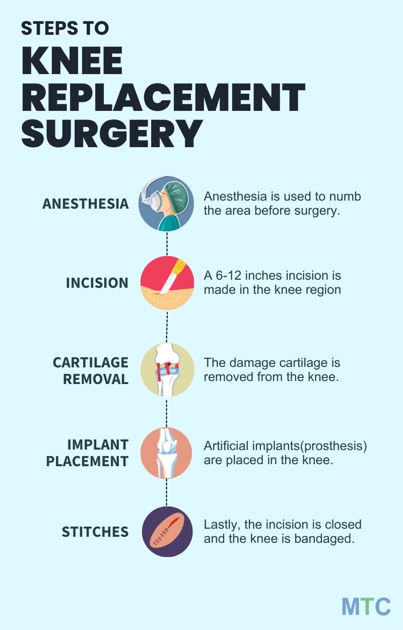 Infographic detailing the procedure of knee replacement