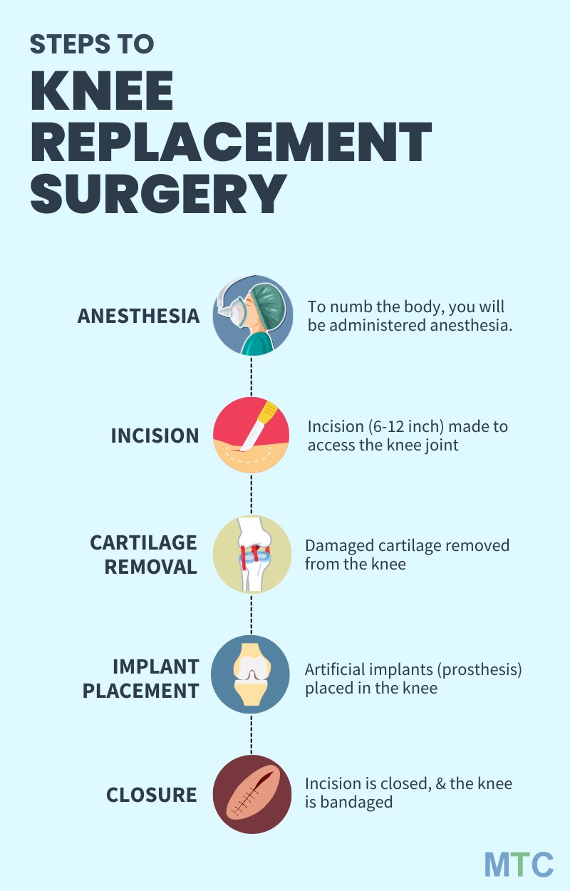 A step by step guide to knee replacement surgery in chennai 