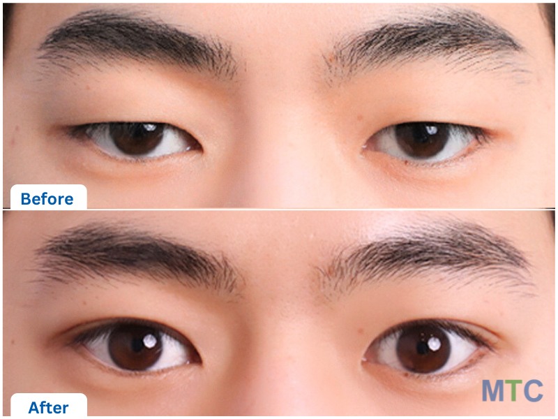 Korean Blepharoplasty Before and After Results