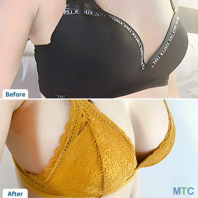 Before and after picture of a patient for Breast Augmentation in Seoul | VG Plastic Surgery