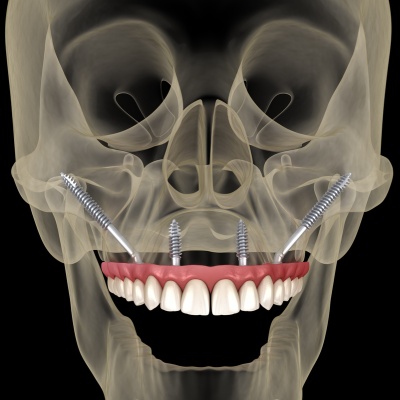 Zygoma Implants