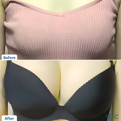 Before and after picture of a patient for Breast Augmentation in Seoul | VG Plastic Surgery