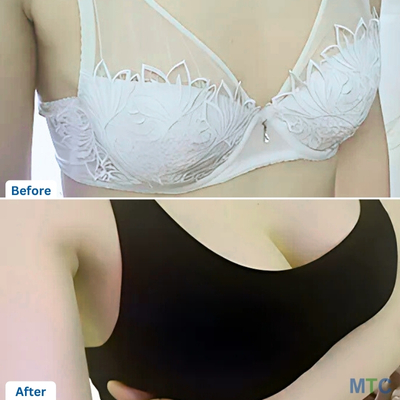 Before and after picture of a patient for Breast Augmentation in Seoul | VG Plastic Surgery