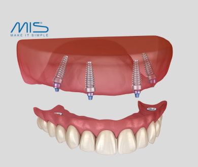 All on 4 implants ( MIS)