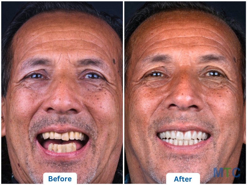 Before and After Dental Treatment