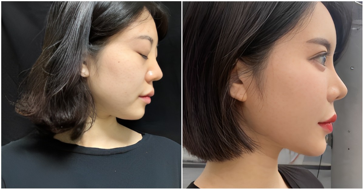 Rhinoplasty in Seoul Korea