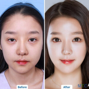 Blepharoplasty in Seoul, Korea Results