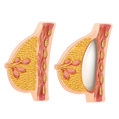 Breast augmentation diagram