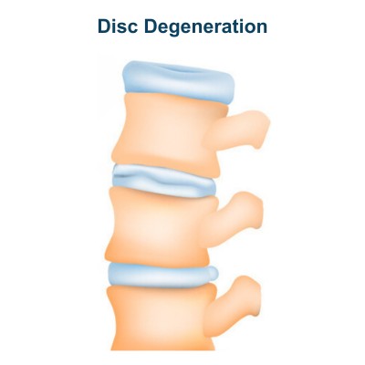 Disc Degeneration - Spinal Disc Breaks Down With Age