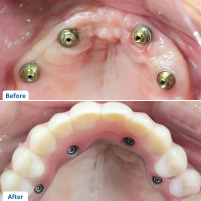 All on 4 Dental Implants