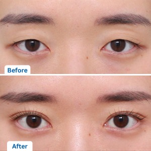 Double Eyelid Surgery or Asian Blepharoplasty