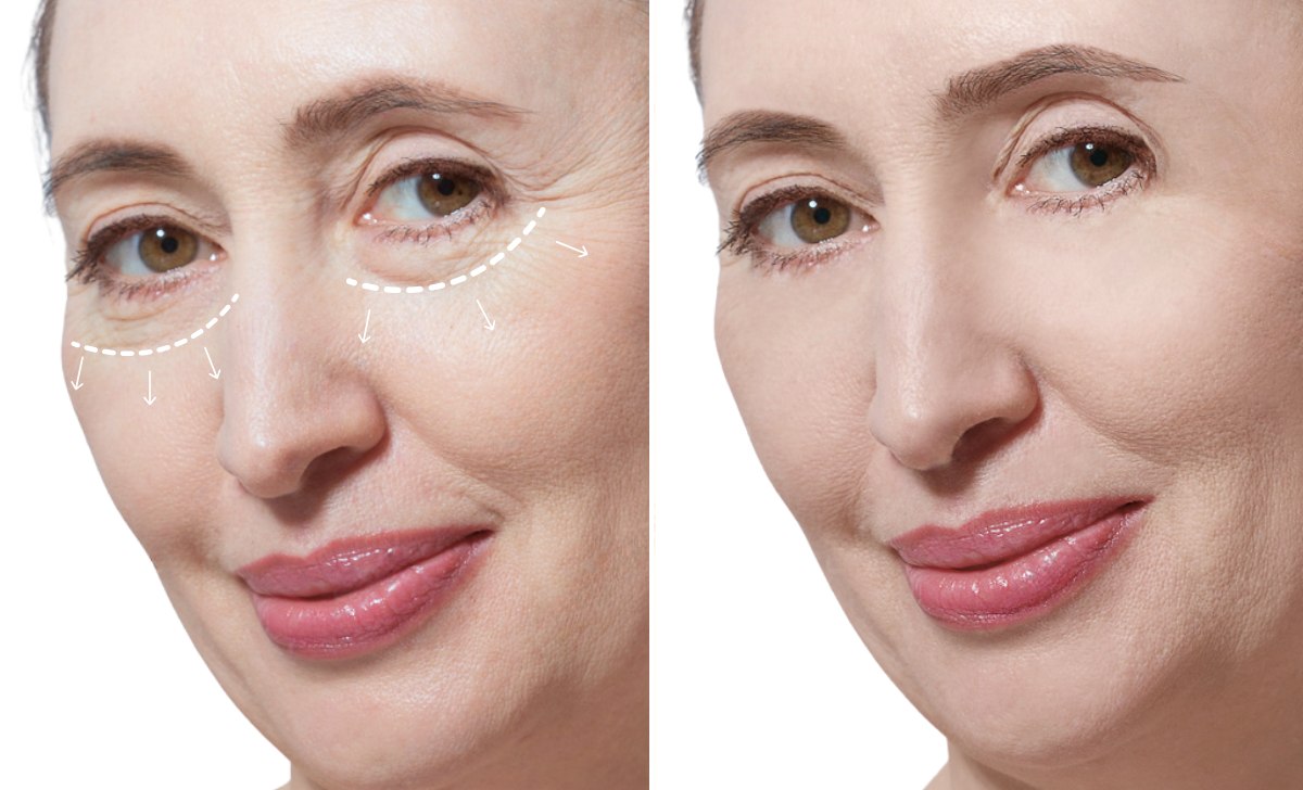 Blepharoplasty in Seoul, Korea