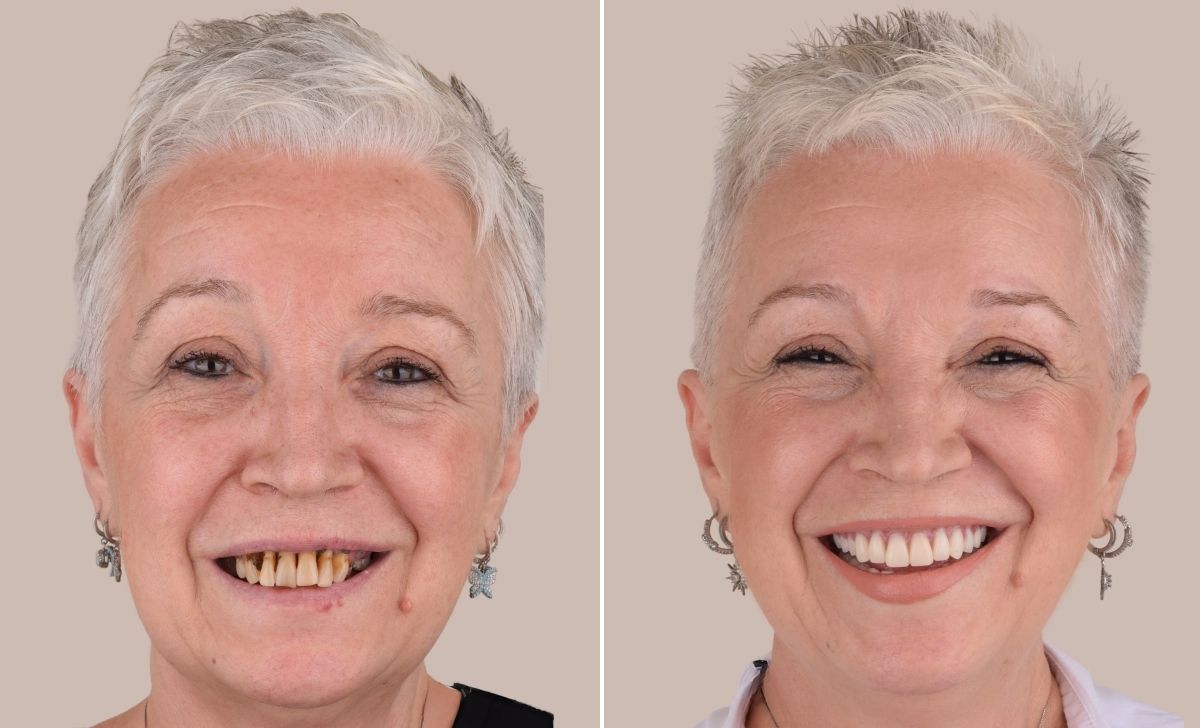 Full Mouth Dental Implants in Turkey