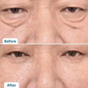 Lower Blepharoplasty