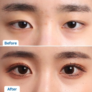 Ptosis correction