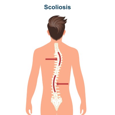 Scoliosis Disease - Spine Bending Sideways