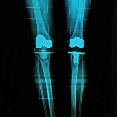 Long-Standing X-ray